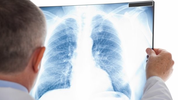 У 8 районах області зросла кількість хворих на туберкульоз